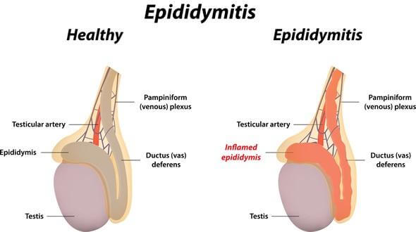 EPIDIDYMITIS CAUSE MALE INFERTILITY