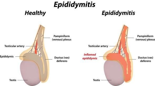 How does epididymitis lead to male infertility Hegde Fertility