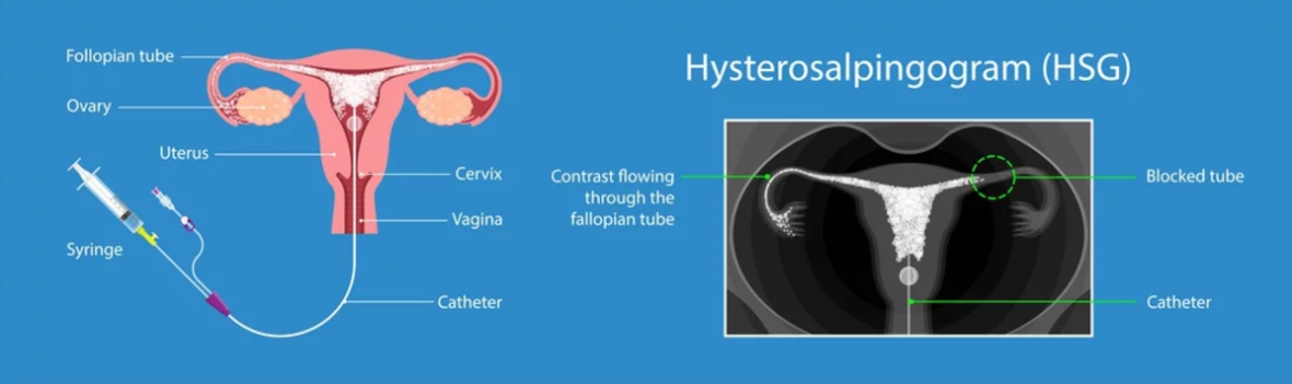 HSG Test